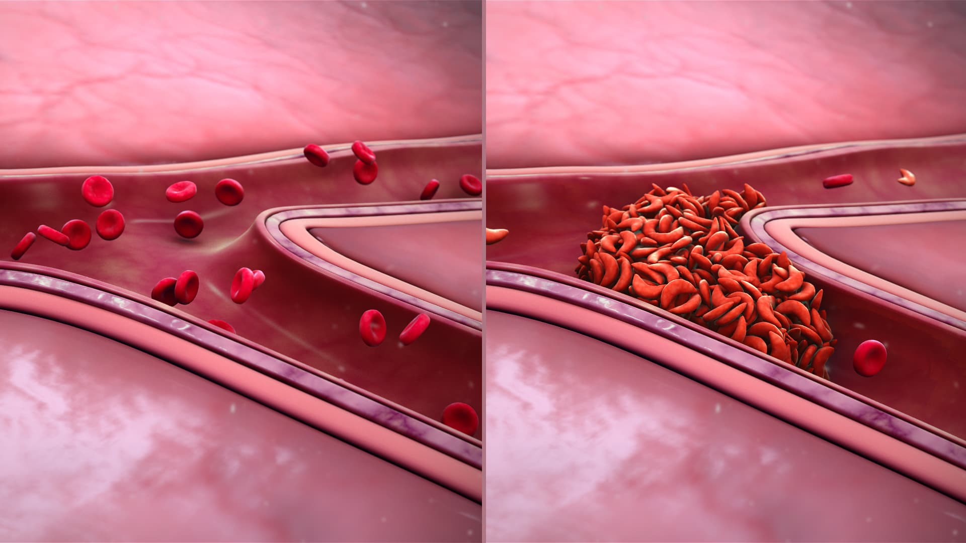Sickle cell nephropathy