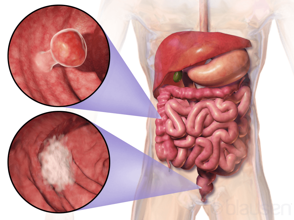 Colorectal cancer