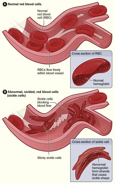 Sickle cell disease